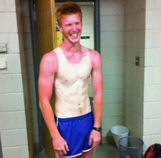 Vest burned on chest